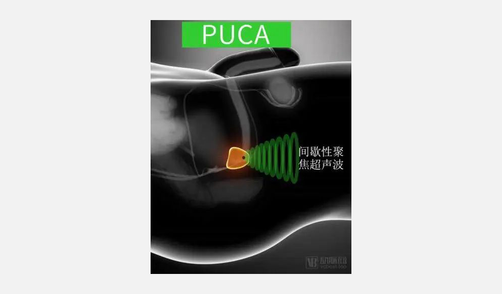 奥昇医疗完成数千万元A轮融资,推进前列腺消融临床研究(图1) 奥昇医疗完成数千万元A轮融资,推进前列腺消融临床研究(图1)
